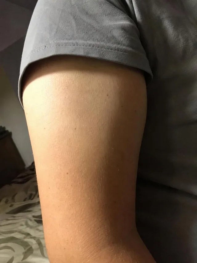 Reference photo of an upper arm before the preview